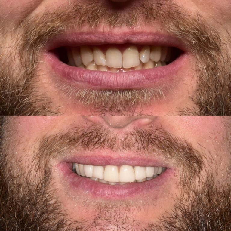 Metamorfoza uśmiechu na jednej wizycie?