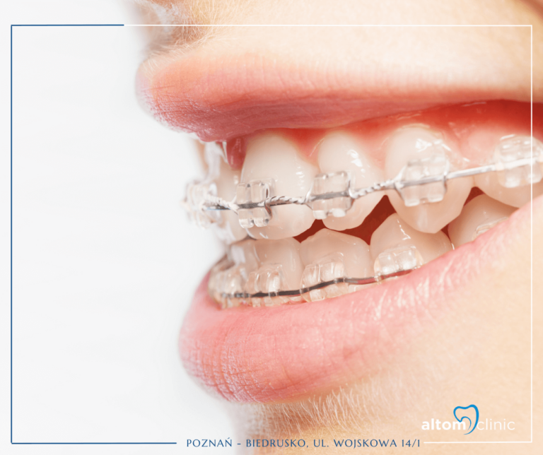 Kiedy warto nosić aparat ortodontyczny i dlaczego?