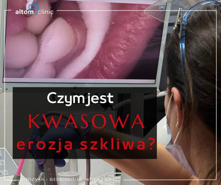 Czy jest kwasowa erozja szkliwa?