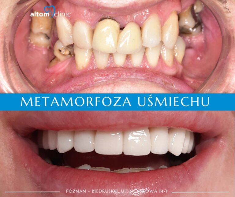 Metamorfoza uśmiechu naszej pacjentki! Przed i po