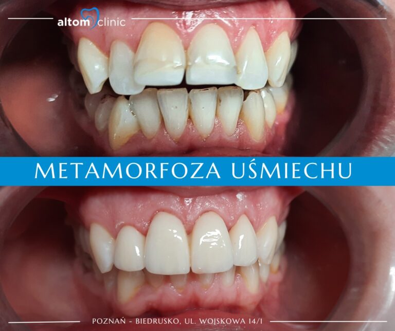 Precyzja i estetyka w jeden dzień