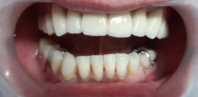 Kompleksowa odbudowa protetyczna – przywracamy funkcję i estetykę uśmiechu w Altom Clinic
