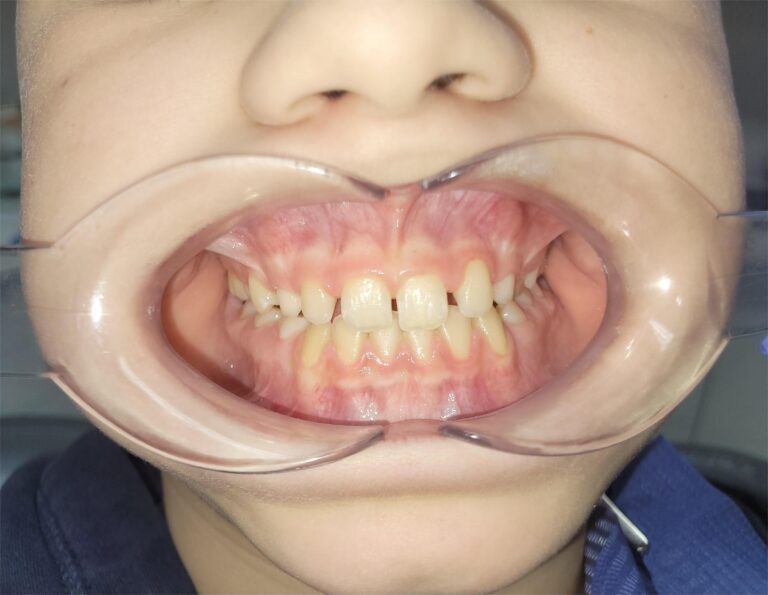 Kompleksowe leczenie ortodontyczne z wykorzystaniem aparatu Hyrax i maski twarzowej – interdyscyplinarne podejście w Altom Clinic