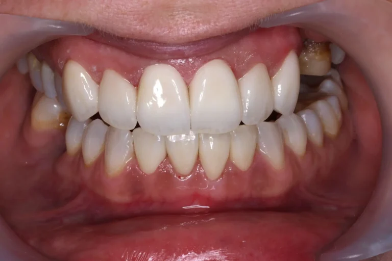 Metamorfoza uśmiechu bez ortodoncji – nowoczesne rozwiązanie w Altom Clinic