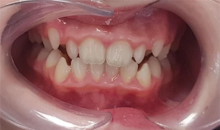 Skuteczne leczenie ortodontyczne u nastolatki – przypadek stłoczenia zębów i braku miejsca na kły