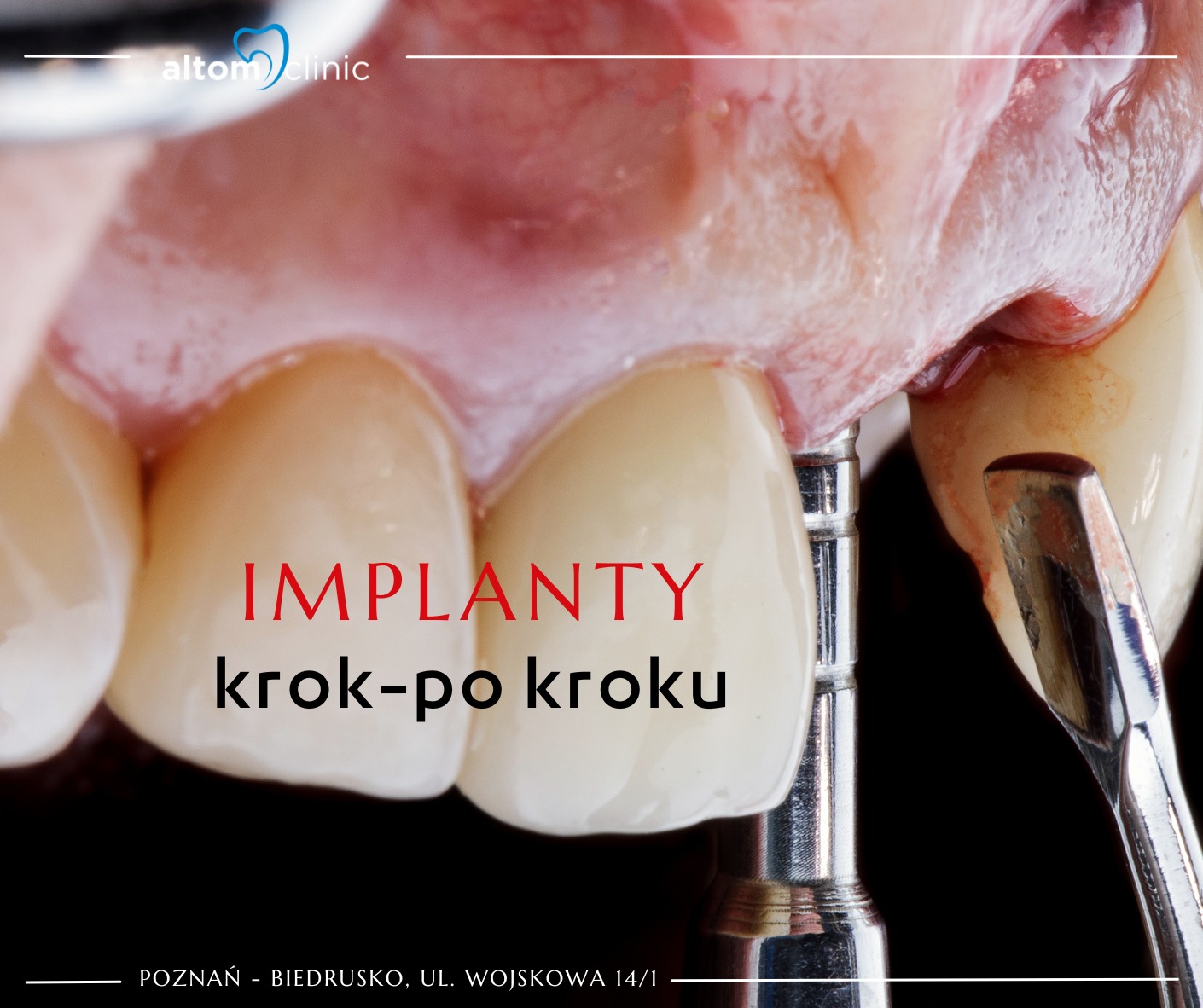 Implanty krok po kroku - od diagnostyki do uśmiechu