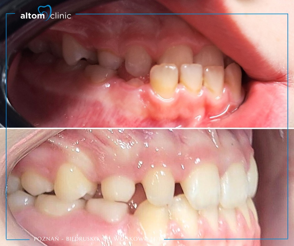 Kompleksowe leczenie ortodontyczne