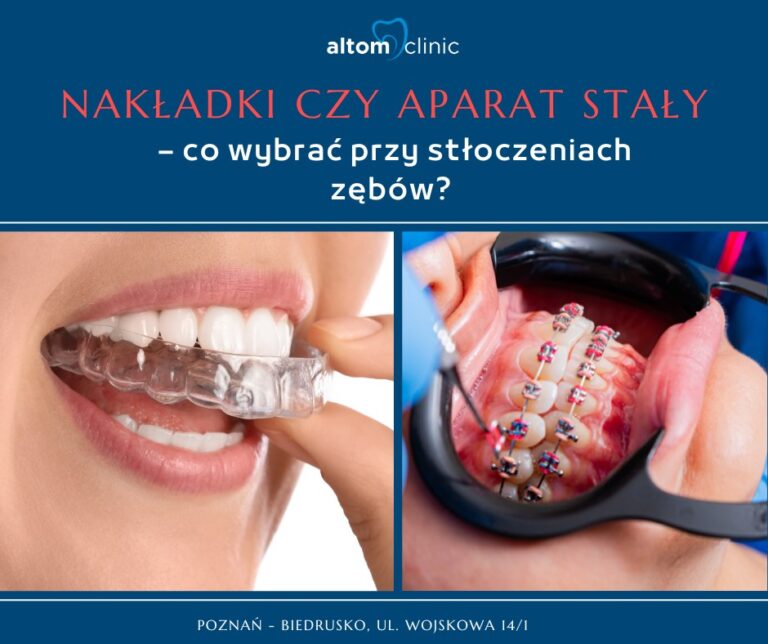 Nakładki czy aparat stały – co wybrać przy stłoczeniach zębów