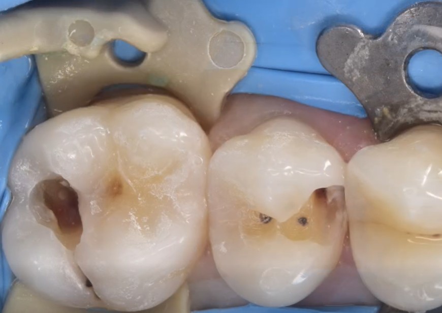 Leczenie ubytku próchnicowego – krok po kroku