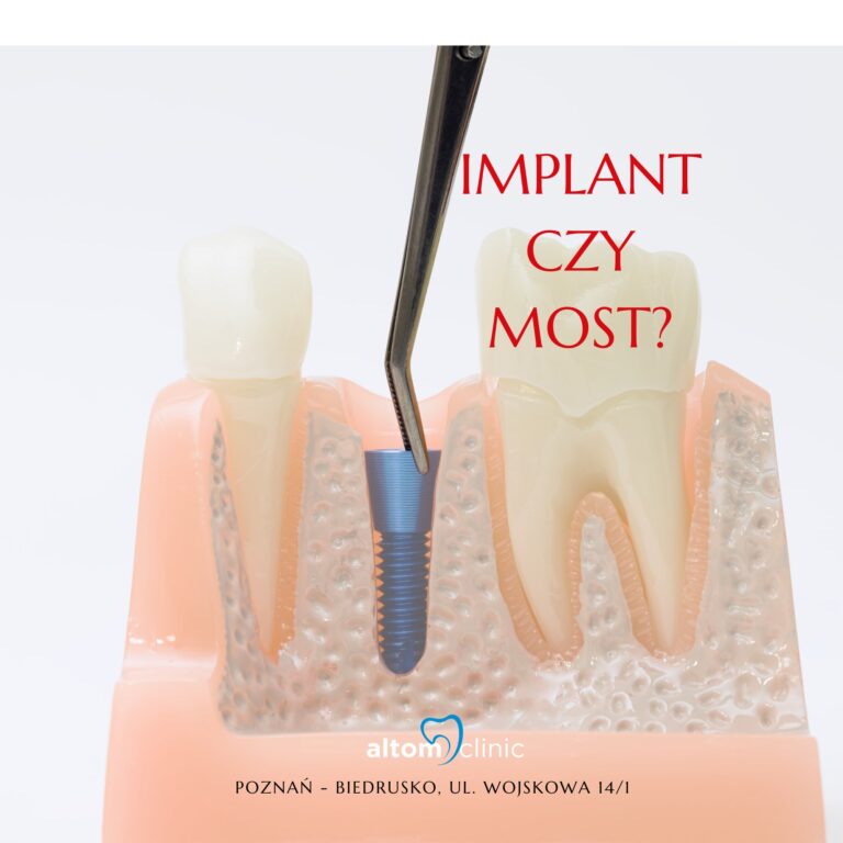 Implant czy most – co wybrać przy braku zęba?