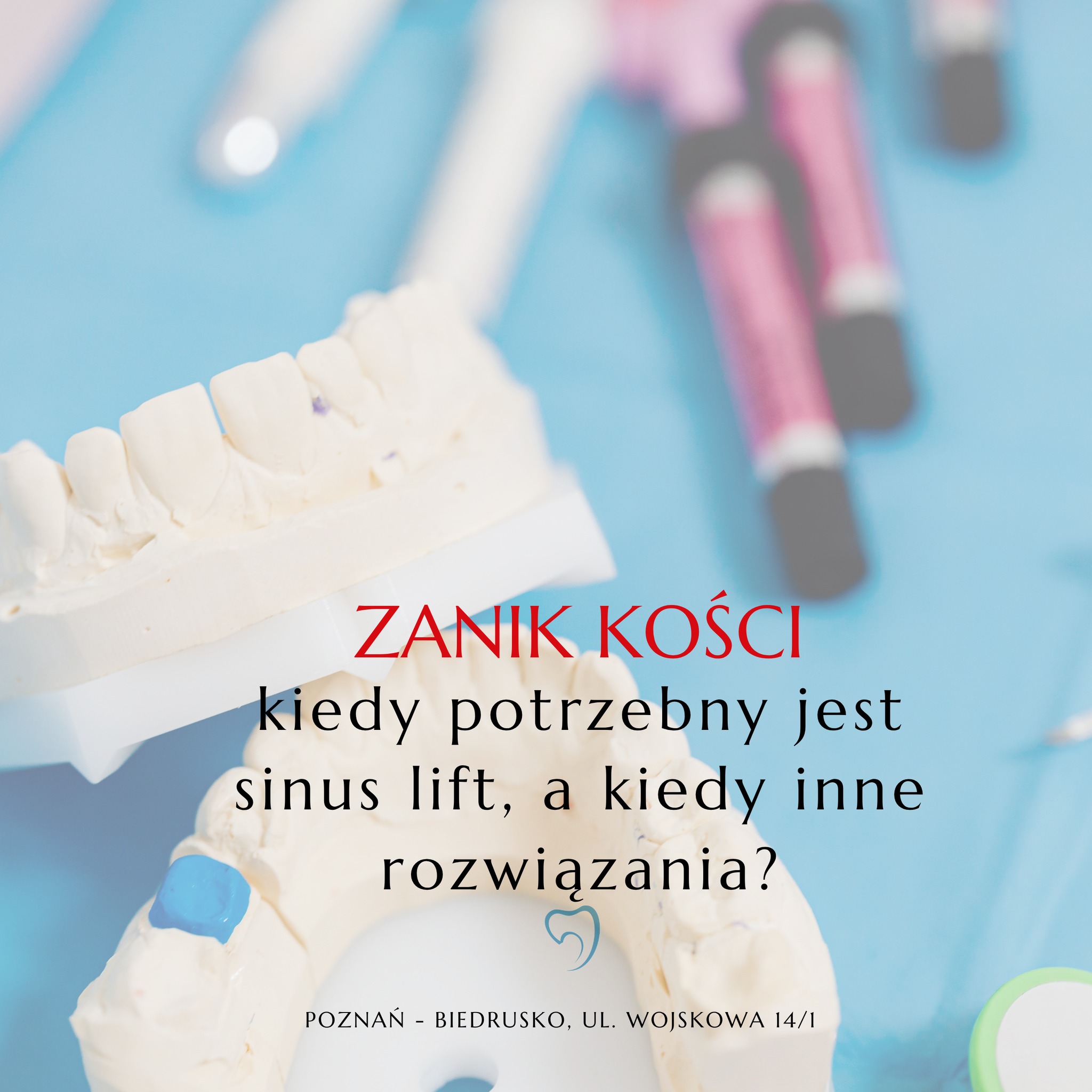 Zanik kości – kiedy potrzebny jest sinus lift, a kiedy inne rozwiązania?