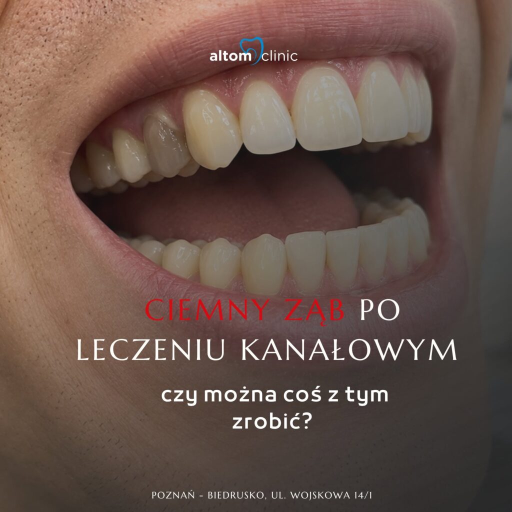 Ciemny ząb po kanałowym? Stomatologia Estetyczna Poznań