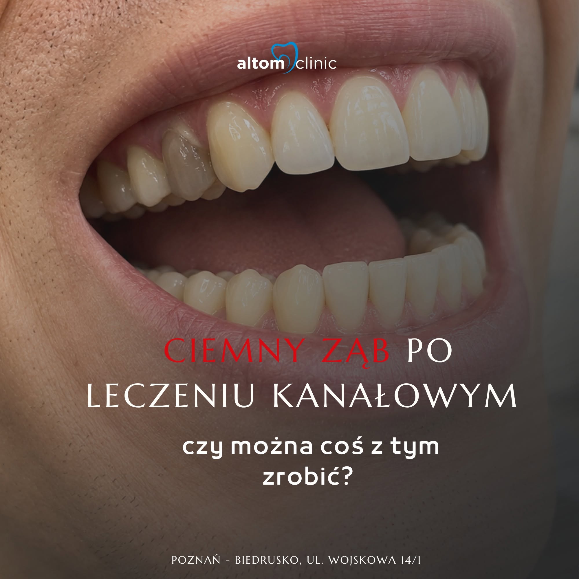 Ciemny ząb po kanałowym? Stomatologia Estetyczna Poznań